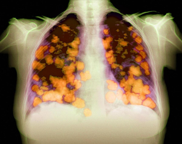 鑫月配 肺癌治疗有些人坚持不下去，原因大部分来自于副反应，如何预防？